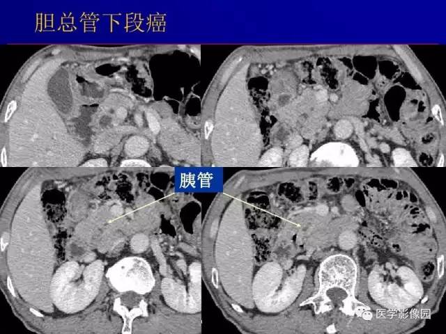 【PPT】胰腺及胆道肿瘤的CT、MRI诊断思路