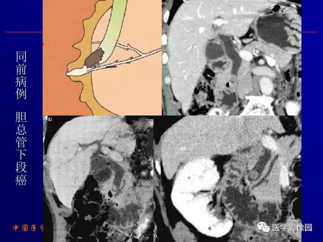 【PPT】胰腺及胆道肿瘤的CT、MRI诊断思路