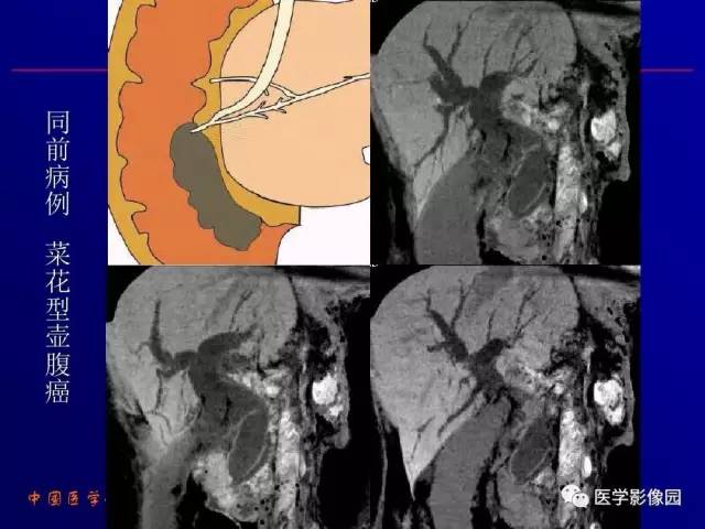 【PPT】胰腺及胆道肿瘤的CT、MRI诊断思路