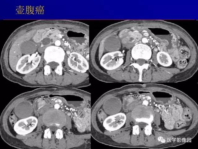 【PPT】胰腺及胆道肿瘤的CT、MRI诊断思路