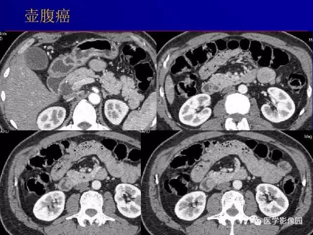 【PPT】胰腺及胆道肿瘤的CT、MRI诊断思路