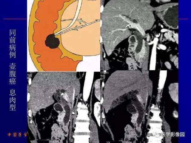 【PPT】胰腺及胆道肿瘤的CT、MRI诊断思路