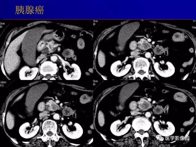 【PPT】胰腺及胆道肿瘤的CT、MRI诊断思路