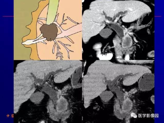 【PPT】胰腺及胆道肿瘤的CT、MRI诊断思路