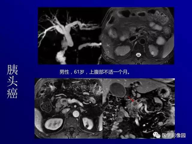 【PPT】胰腺及胆道肿瘤的CT、MRI诊断思路
