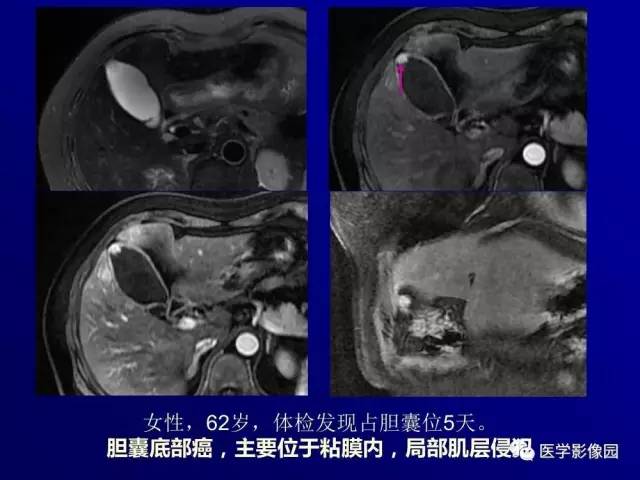 【PPT】胰腺及胆道肿瘤的CT、MRI诊断思路