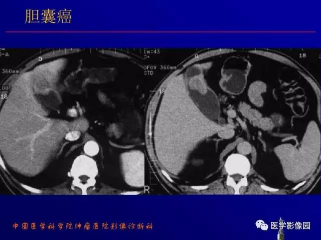【PPT】胰腺及胆道肿瘤的CT、MRI诊断思路