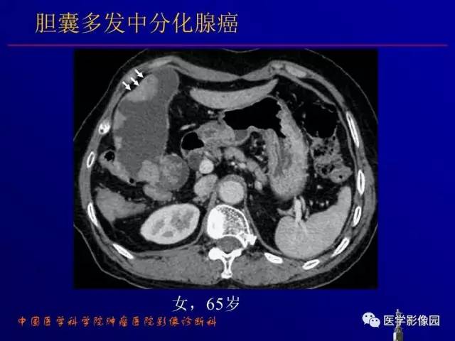 【PPT】胰腺及胆道肿瘤的CT、MRI诊断思路