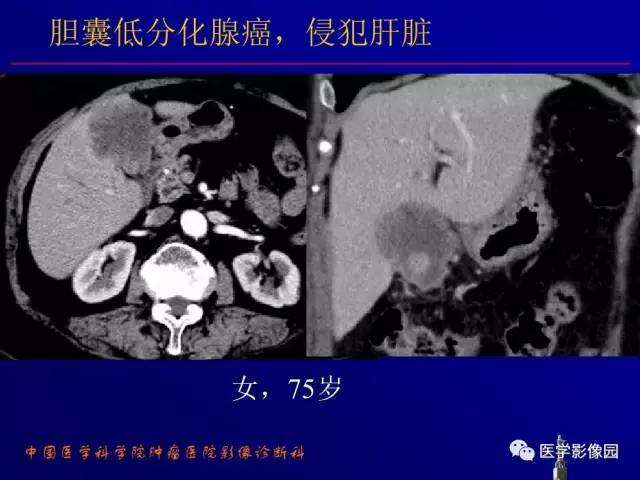 【PPT】胰腺及胆道肿瘤的CT、MRI诊断思路