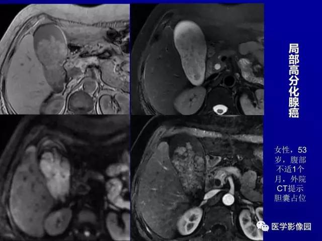 【PPT】胰腺及胆道肿瘤的CT、MRI诊断思路