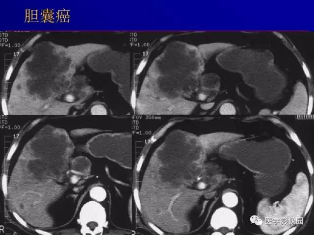 【PPT】胰腺及胆道肿瘤的CT、MRI诊断思路