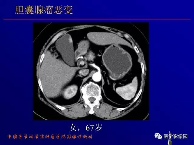 【PPT】胰腺及胆道肿瘤的CT、MRI诊断思路