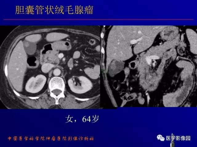 【PPT】胰腺及胆道肿瘤的CT、MRI诊断思路