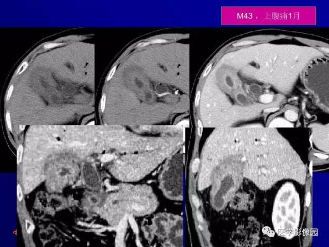 【PPT】胰腺及胆道肿瘤的CT、MRI诊断思路
