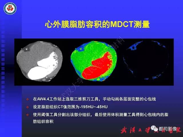 【PPT】MDCT定量评价冠心病患者心外膜脂肪组织与主动脉弹性及左心室舒张功能相关性
