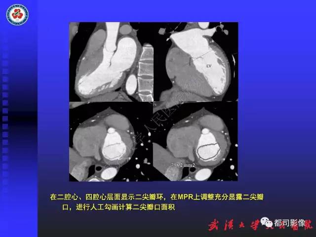 【PPT】MDCT定量评价冠心病患者心外膜脂肪组织与主动脉弹性及左心室舒张功能相关性