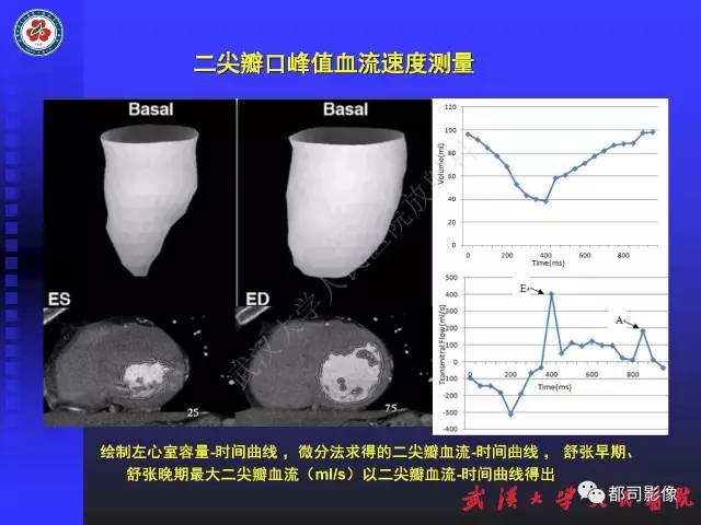 【PPT】MDCT定量评价冠心病患者心外膜脂肪组织与主动脉弹性及左心室舒张功能相关性