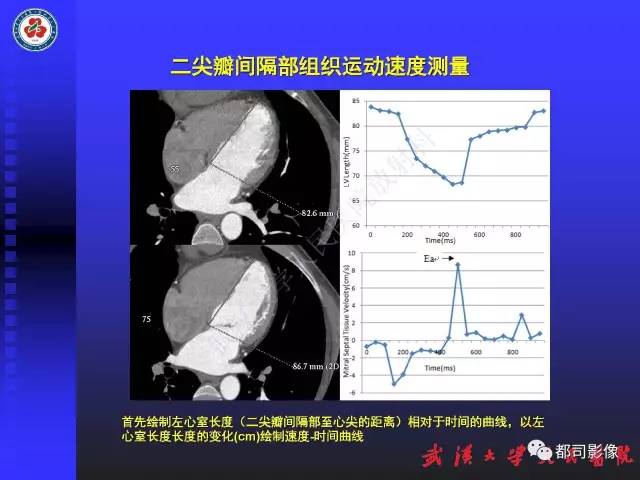 【PPT】MDCT定量评价冠心病患者心外膜脂肪组织与主动脉弹性及左心室舒张功能相关性