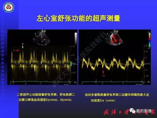 【PPT】MDCT定量评价冠心病患者心外膜脂肪组织与主动脉弹性及左心室舒张功能相关性