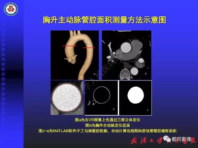 【PPT】MDCT定量评价冠心病患者心外膜脂肪组织与主动脉弹性及左心室舒张功能相关性