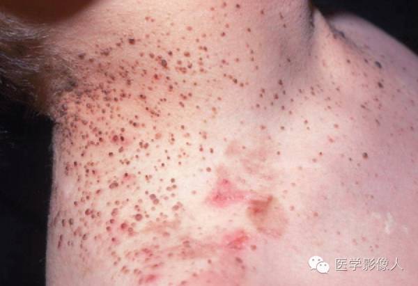 15种累及骨骼与皮肤综合征 15种累及骨骼与皮肤综合征