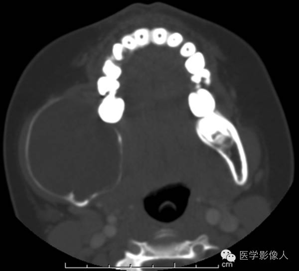 15种累及骨骼与皮肤综合征 15种累及骨骼与皮肤综合征