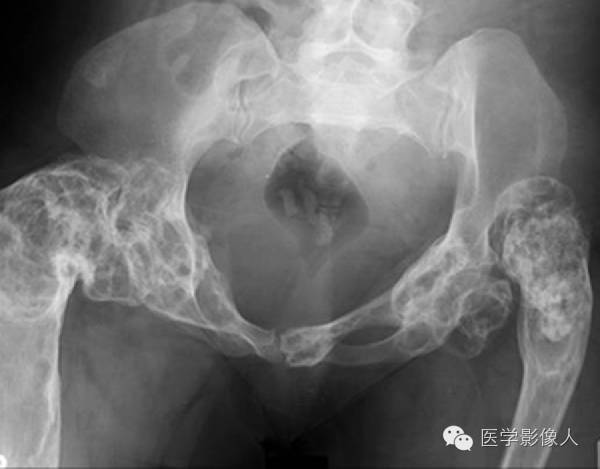 15种累及骨骼与皮肤综合征 15种累及骨骼与皮肤综合征
