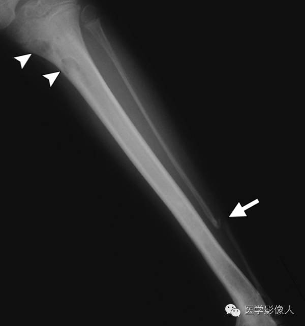 15种累及骨骼与皮肤综合征 15种累及骨骼与皮肤综合征