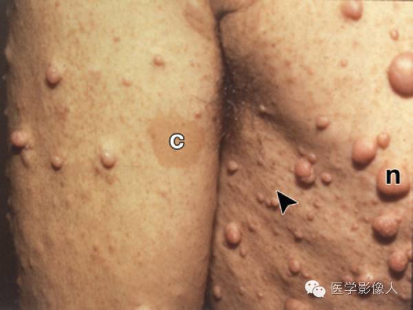 15种累及骨骼与皮肤综合征 15种累及骨骼与皮肤综合征