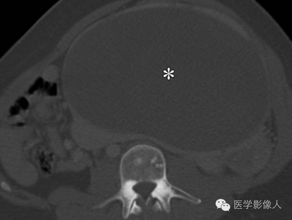 15种累及骨骼与皮肤综合征 15种累及骨骼与皮肤综合征