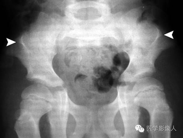 15种累及骨骼与皮肤综合征 15种累及骨骼与皮肤综合征
