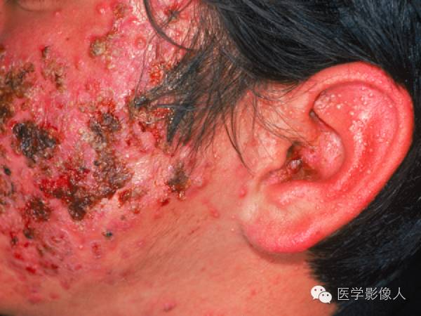15种累及骨骼与皮肤综合征 15种累及骨骼与皮肤综合征