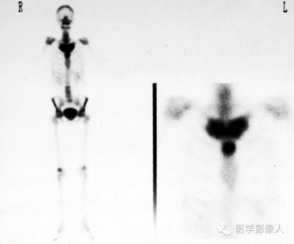 15种累及骨骼与皮肤综合征 15种累及骨骼与皮肤综合征