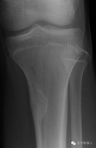 15种累及骨骼与皮肤综合征 15种累及骨骼与皮肤综合征