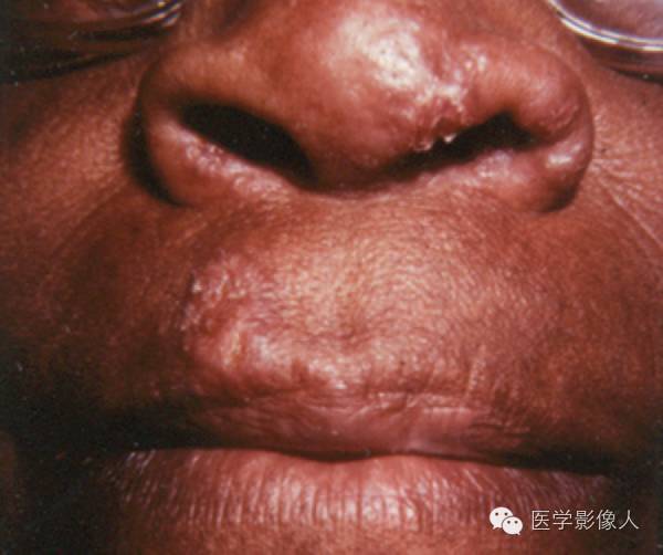 15种累及骨骼与皮肤综合征 15种累及骨骼与皮肤综合征