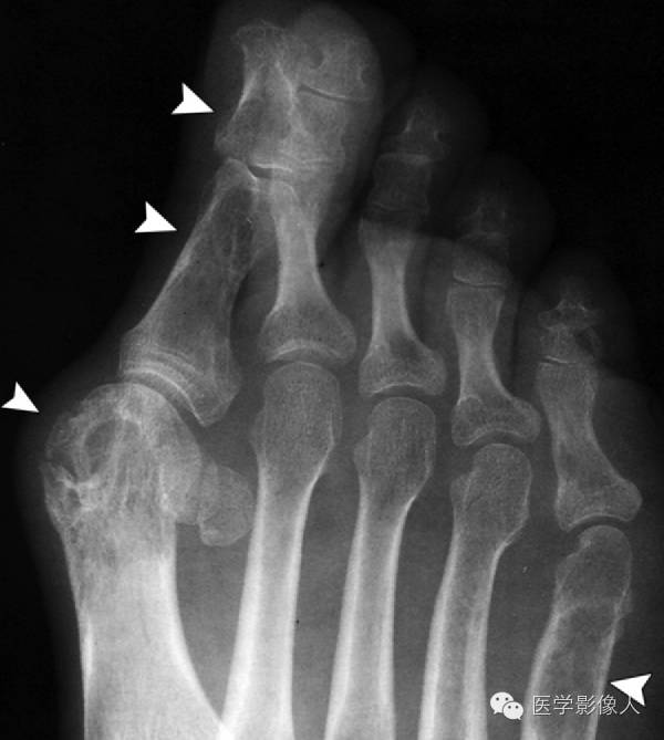 15种累及骨骼与皮肤综合征 15种累及骨骼与皮肤综合征