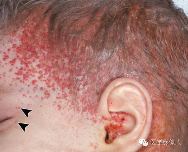 15种累及骨骼与皮肤综合征 15种累及骨骼与皮肤综合征