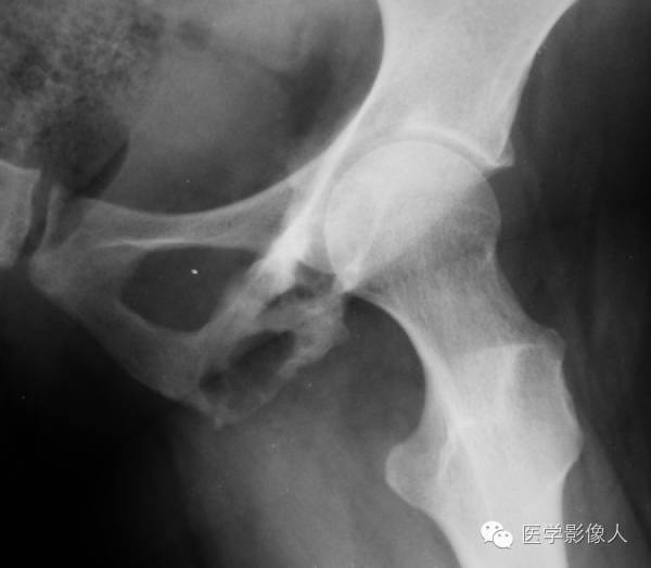 15种累及骨骼与皮肤综合征 15种累及骨骼与皮肤综合征