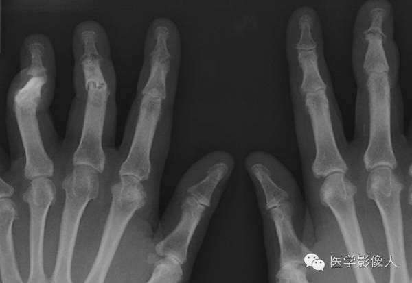 15种累及骨骼与皮肤综合征 15种累及骨骼与皮肤综合征