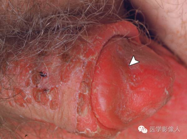 15种累及骨骼与皮肤综合征 15种累及骨骼与皮肤综合征