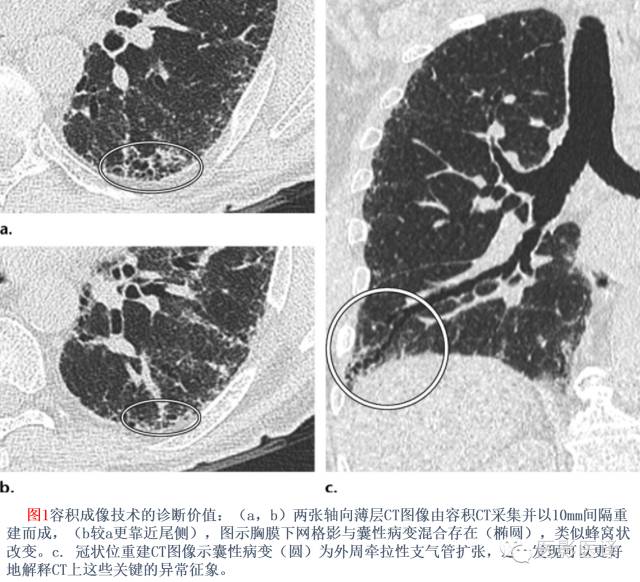 特发性间质性肺炎的分类:自2002年以来知识新进展 特发性间质性肺炎的分类:自2002年以来知识新进展