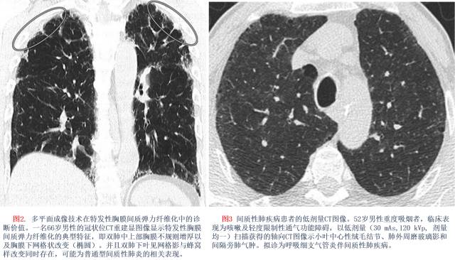 特发性间质性肺炎的分类:自2002年以来知识新进展 特发性间质性肺炎的分类:自2002年以来知识新进展