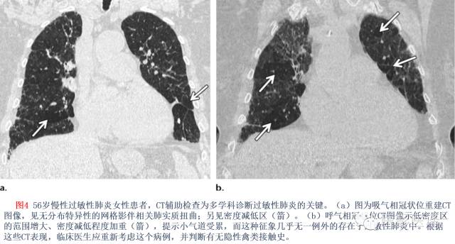 特发性间质性肺炎的分类:自2002年以来知识新进展 特发性间质性肺炎的分类:自2002年以来知识新进展
