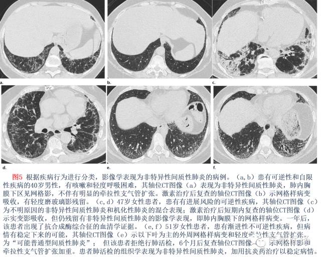 特发性间质性肺炎的分类:自2002年以来知识新进展 特发性间质性肺炎的分类:自2002年以来知识新进展