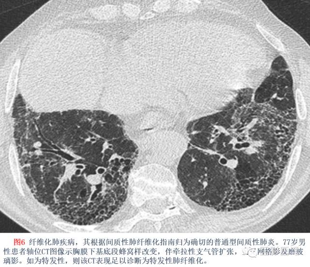 特发性间质性肺炎的分类:自2002年以来知识新进展 特发性间质性肺炎的分类:自2002年以来知识新进展
