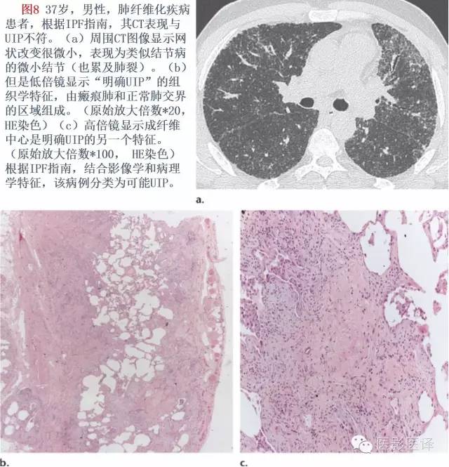 特发性间质性肺炎的分类:自2002年以来知识新进展 特发性间质性肺炎的分类:自2002年以来知识新进展