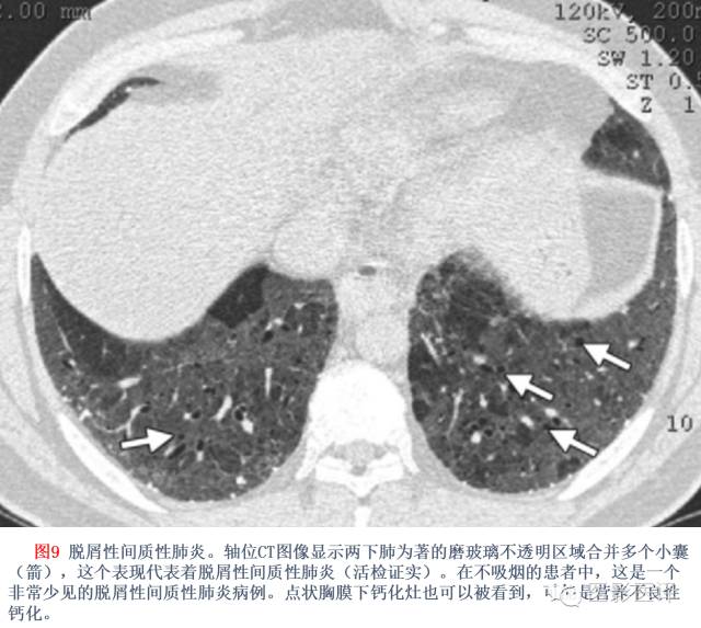 特发性间质性肺炎的分类:自2002年以来知识新进展 特发性间质性肺炎的分类:自2002年以来知识新进展