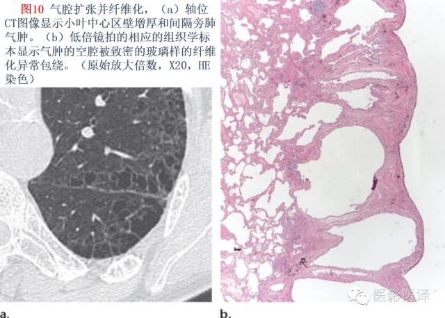 特发性间质性肺炎的分类:自2002年以来知识新进展 特发性间质性肺炎的分类:自2002年以来知识新进展