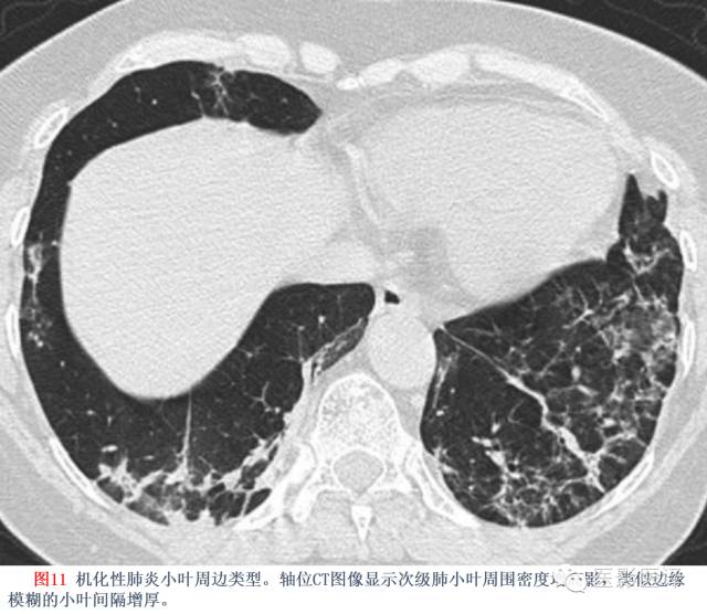 特发性间质性肺炎的分类:自2002年以来知识新进展 特发性间质性肺炎的分类:自2002年以来知识新进展