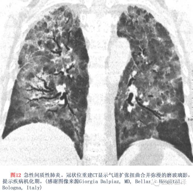 特发性间质性肺炎的分类:自2002年以来知识新进展 特发性间质性肺炎的分类:自2002年以来知识新进展